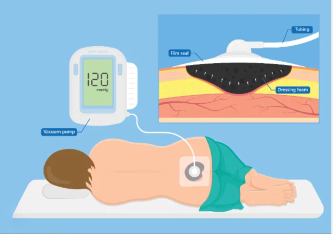 Webinaire : Thérapie par pression négative : Optimiser la prise en charge des plaies complexes
